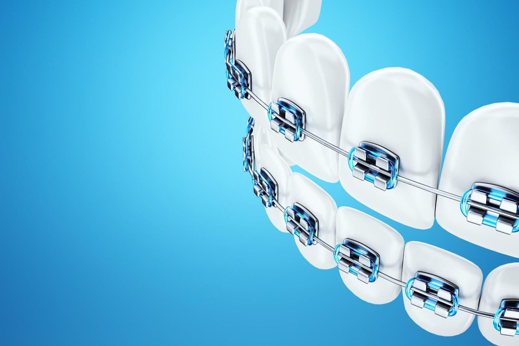 How Should Patients with Braces Properly Brush Their Teeth? RANVOO